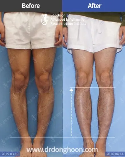 ยืดกระดูกน่อง6.5 เซนติเมตร ร่วมกับการแก้ไขกระดูกผิดรูปด้วย