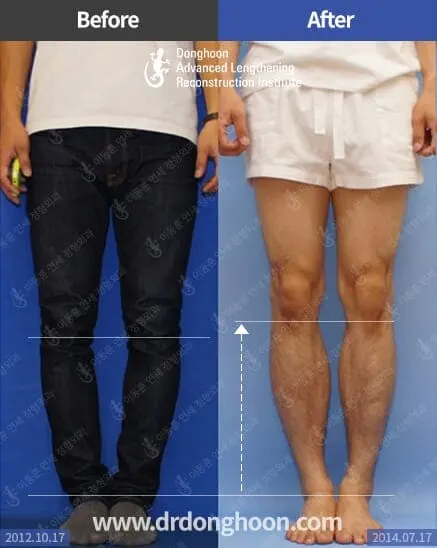 ยืดกระดูกน่อง 7 เซนติเมตร ร่วมกับการแก้ไขกระดูกผิดรูปด้วย