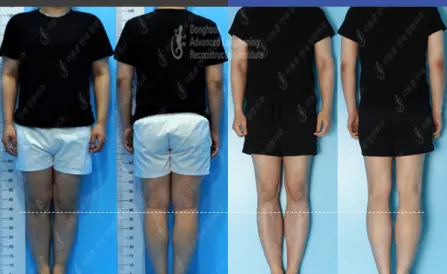 6.5cm of Tibial Lengthening by LON method