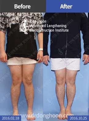 อาการขารูปตัวเอ็กซ์ที่รักษาด้วยการผ่าตัด