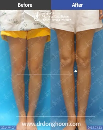 ยืดกระดูกน่อง 6.5 เซนติเมตร ร่วมกับการแก้ไขกระดูกผิดรูปด้วย