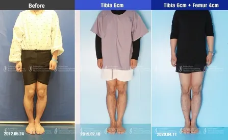Increasing 10cm of Height by Cosmetic Leg Lengthening Surgery