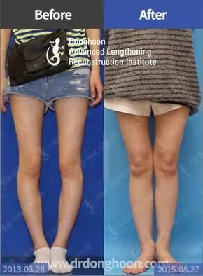 แก้ใขกระดูกน่องหมุนผิดปกติกกรณีเป็นโรคกระดูกหมุนผิดปกติเพียงอย่างเดียว