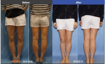 Bowlegs Correction by High Tibial Osteotomy
