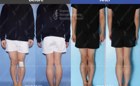 6.5cm of Tibial Lengthening by LON method