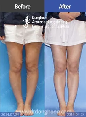 แก้ไขควบคู่กันหากมีความผิดปกติทั้งมุมและการหมุน