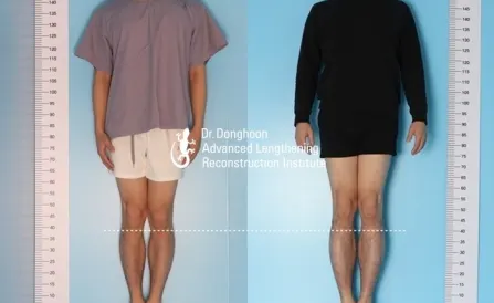 6.5cm of Tibial Lengthening by LON method
