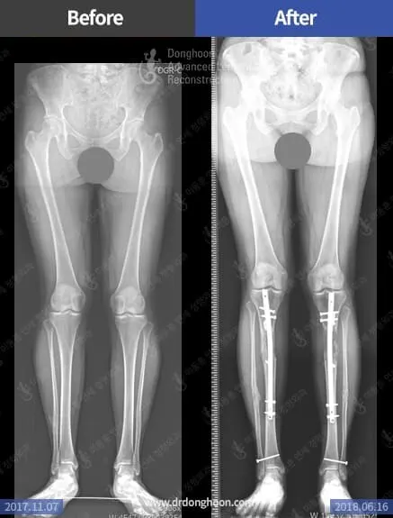 ยืดกระดูก พร้อมกับแก้ไขการเดินเป็นรูปเลขแปด(out-toeing gait) ( LON 6 เซนติเมตร)