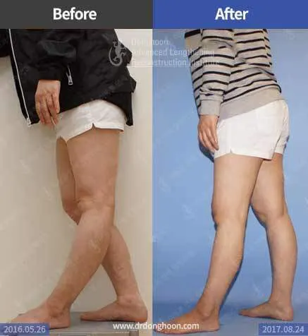 การรักษาอาการเข่าแอ่นด้วยการผ่าตัด