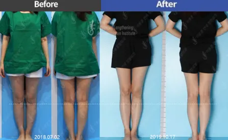 5.8cm of Tibial Lengthening by LON method