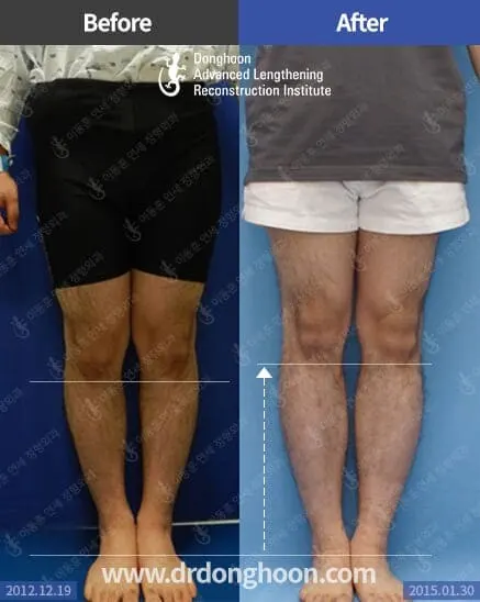 ยืดกระดูกน่อง 6.5 เซนติเมตร ร่วมกับการแก้ไขกระดูกผิดรูปด้วย