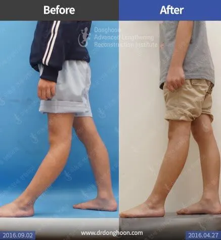การรักษาอาการเข่าแอ่นด้วยการผ่าตัด