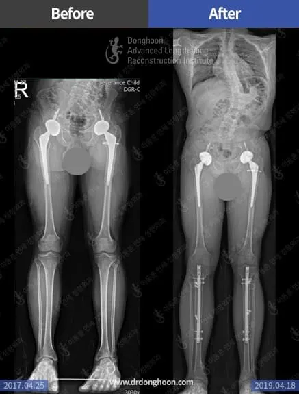 ผ่าตัดส่วนสูง ในผู้ที่เป็นโรคแคระไม่สมส่วน (spondyloepiphyseal dysplasia)
