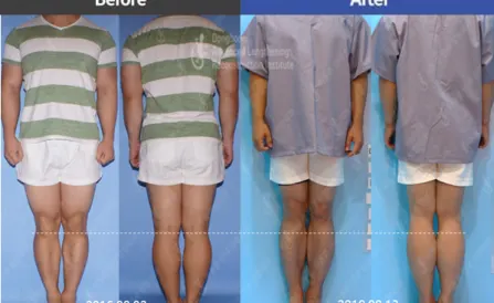 7cm of Tibial Lengthening by LON method