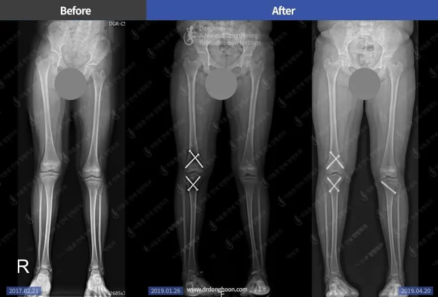 Pediatric Leg Length Discrepancy 2cm
