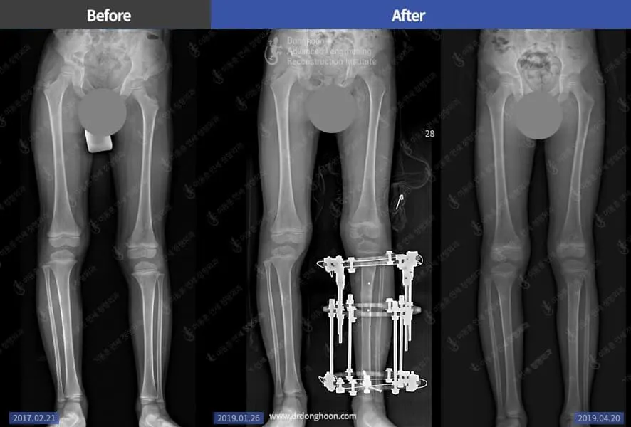 Congenital hemihypertrophy- leg length discrepancy- treated by lengthening of leg