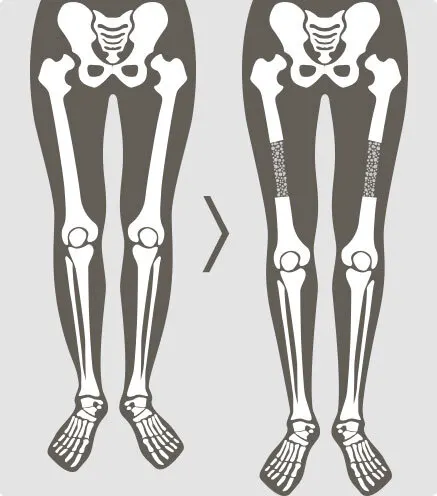 การผ่าตัดยืดกระดูกทั่วไป (ต้นขา)