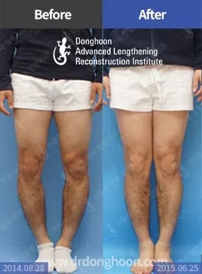 แก้ไขมุมน่องผิดปกติกรณีมุมน่องผิดปกติเพียงอย่างเดียว