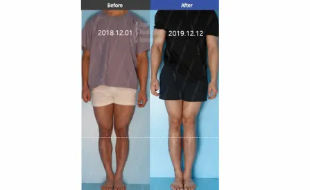 6.8cm of Tibial Lengthening by LON method
