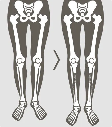 การผ่าตัดยืดกระดูกทั่วไป (น่อง)