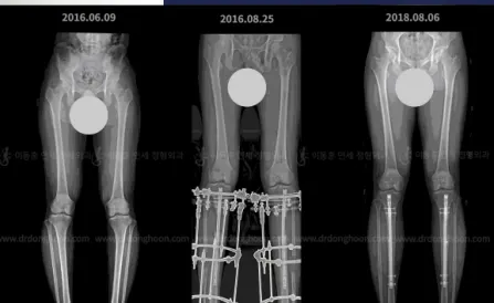 Cosmetic Leg Lengthening Surgery and Bowlegs Correction