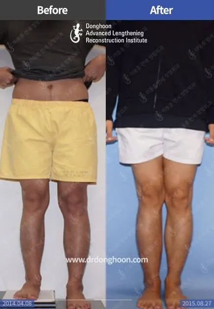 하지부동 종아리 4cm