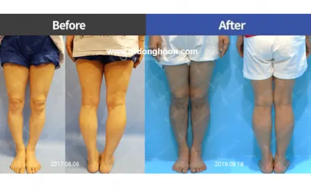 Bowleg Correction