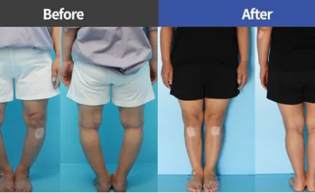Bowlegs and Knee Arthritis Treatment